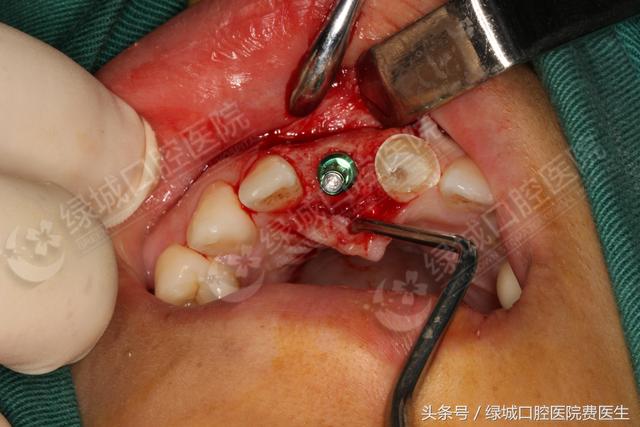 人类的第三副牙齿——种植牙