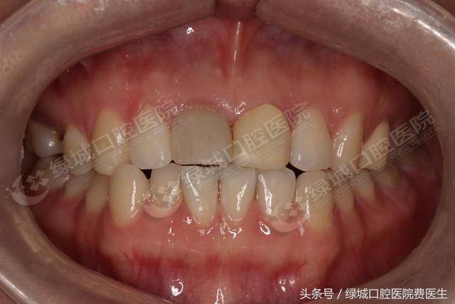 人类的第三副牙齿——种植牙