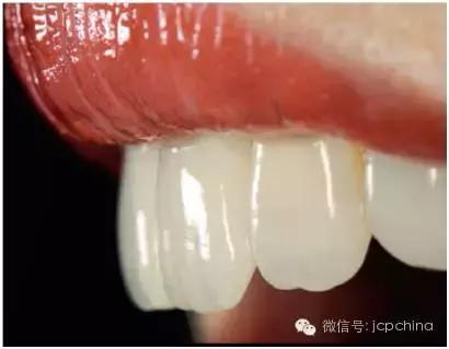 口腔美学修复策略之牙齿尺寸