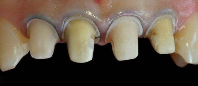 为什么有些烤瓷牙做了会让牙龈变黑？